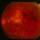 Amikacin Retinal Toxicity